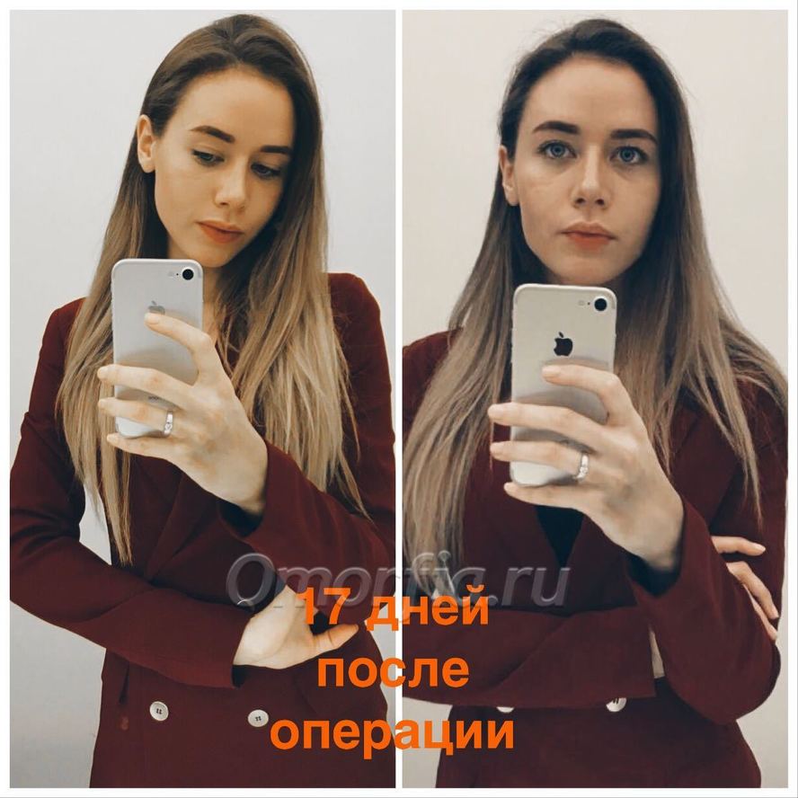 Январь 2 месяца после Оп