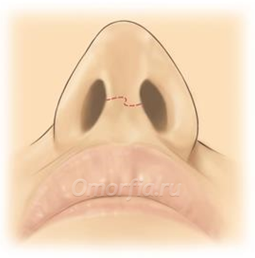 http://www.doctorbabayan.ru/images/artical/otkrytaja-rinoplastika.jpg