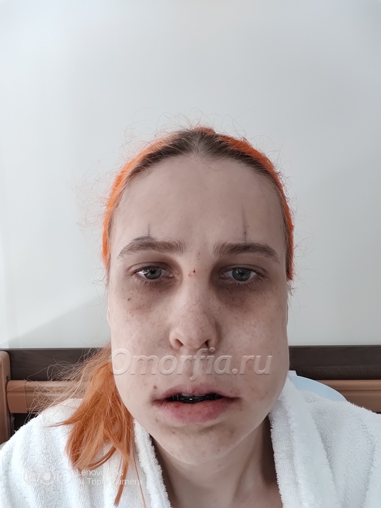 на утро послек операции 1