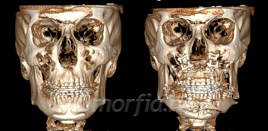 beforeafter_front